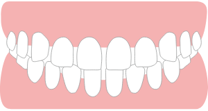 前歯のすき間が気になるすきっ歯