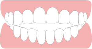 前歯が咬み合わない開咬