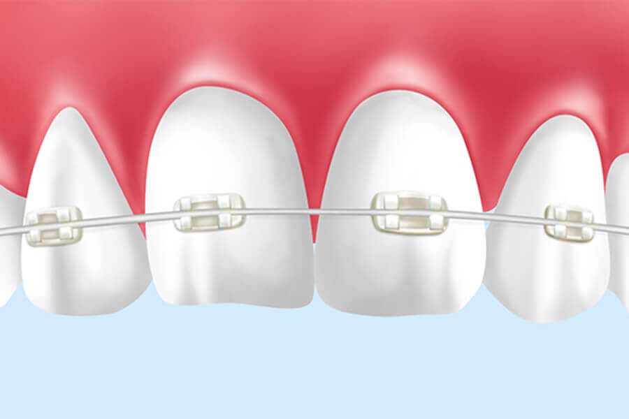 金属・セラミック・ホワイトワイヤーでのブラケット治療